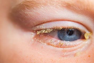 👁️‍🗨️Очі печуть, закисають, сльозяться?.. Що це і як собі допомогти? Червоні, печуть, ніби піску насипали? Це може бути кон