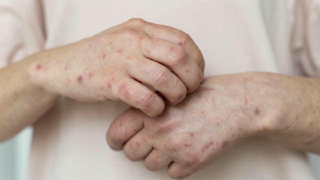 😷 На Буковині захворюваність на кір зросла у майже 30 разів за перше півріччя цього року. Наразі в області зареєстрували 329