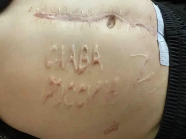 Нещодавно повернутий український військовополонений, якого РФ піддала тортурам і затаврували шрамом з написом «Слава Росії», 